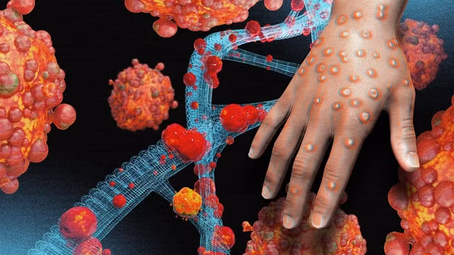 Bệnh đậu mùa khỉ: Ai dễ nhiễm và dễ bị bệnh nặng?