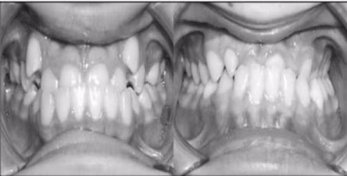 can nan chinh rang cho tre o tuoi nao