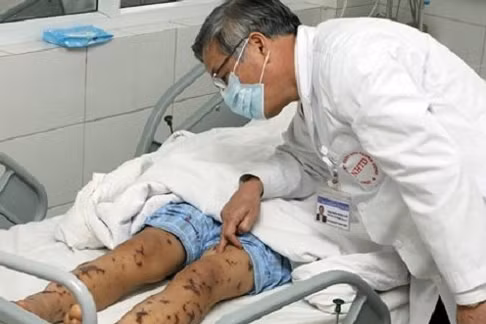 chay vac xin vi dich nao mo cau co nguy co xuat hien