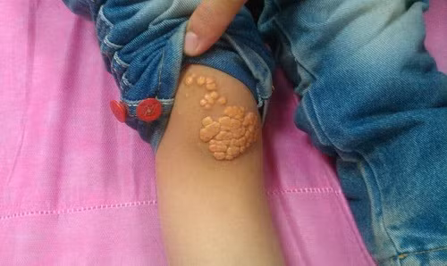 dau hieu canh bao som benh tim mach