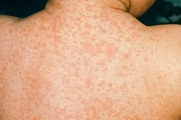 tre chua toi tuoi tiem phong soi lam the nao de phong benh day