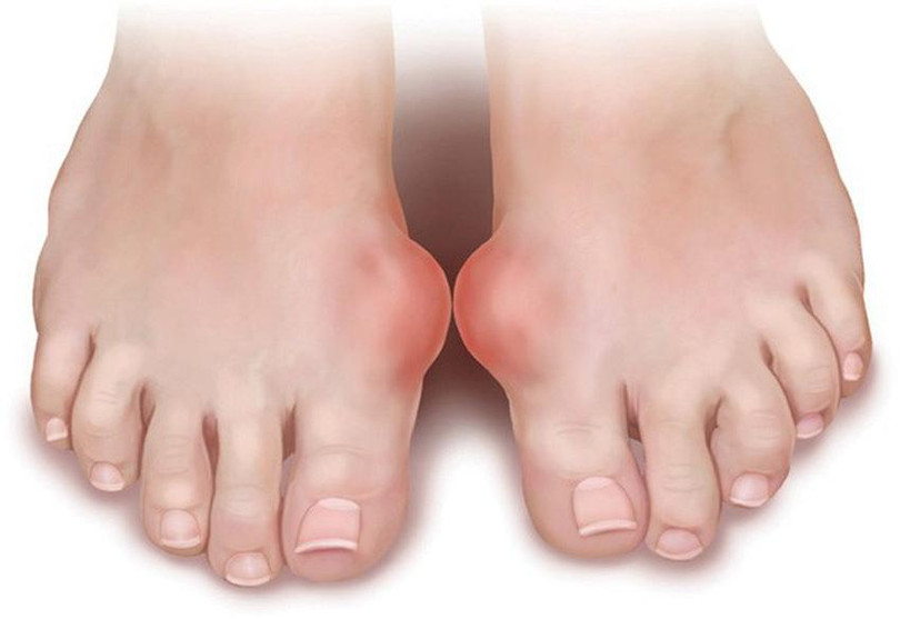 Triệu chứng bệnh gút thường xuất hiện ở ngón chân cái Gút cấp1.jpg