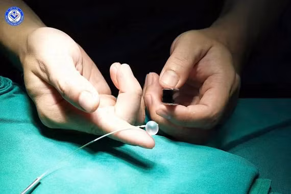 Lần đầu tiên tại Việt Nam: Đặt bóng vào khí quản thai nhi 30 tuần tuổi, cứu trẻ từ trong bụng mẹ