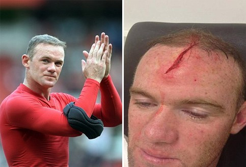 Rooney của ngày thi đấu tuần qua (trái) và hình ảnh chấn thương trước đó.