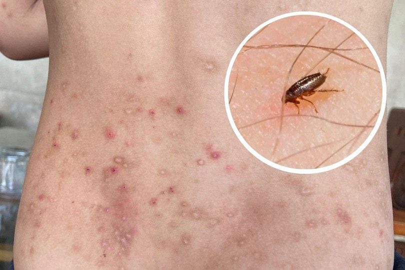 Tác hại cắn người gây ngứa ngáy và viêm nhiễm trên da diet-bo-chet-1.jpg