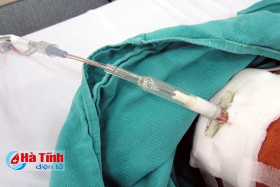 Một trường hợp xuất huyết não được sử dụng kỹ thuật thuật đo áp lực nội sọ qua Catheter não thất tại Bệnh viện Đa khoa Hà Tĩnh.