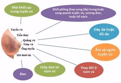 Ung thư vú: Những dấu hiệu 'tử thần' ảnh 2 Ung thư vú: Những dấu hiệu 'tử thần' ảnh 2