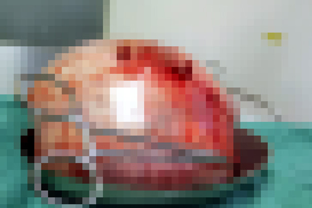 Cắt bỏ khối u xơ nặng gần 4kg trong tử cung bệnh nhân nữ