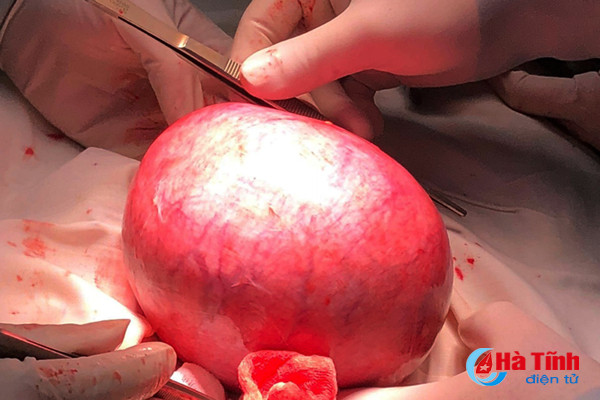 bvdk duc tho phau thuat lay khoi u xo tu cung nang 2 7 kg