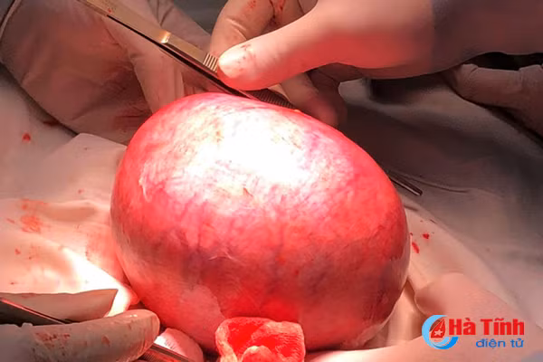 bvdk duc tho phau thuat lay khoi u xo tu cung nang 2 7 kg