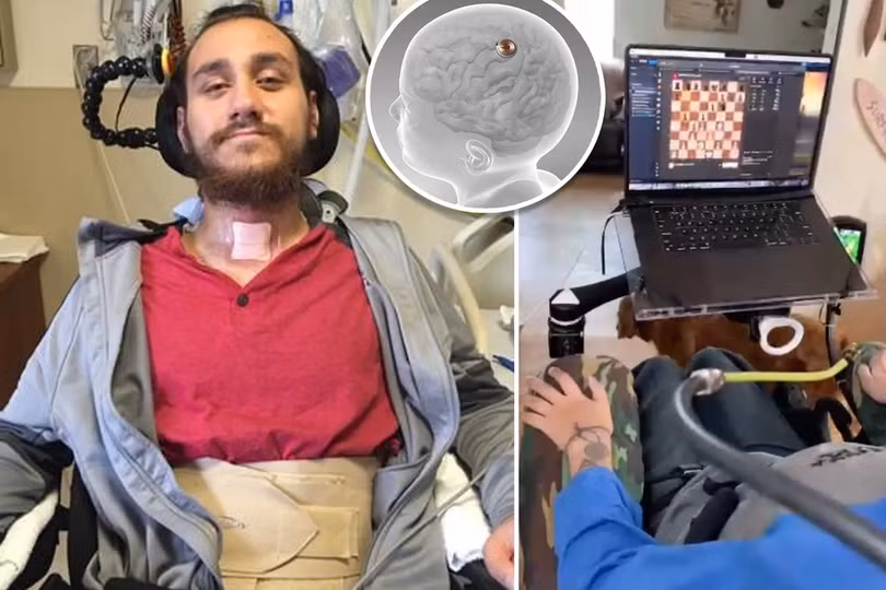 Nolan Arbaugh, người đầu tiên được cấy chip não của Neuralink, đã có thể điều khiển máy tính và chơi game bằng suy nghĩ (Ảnh: Neuralink).