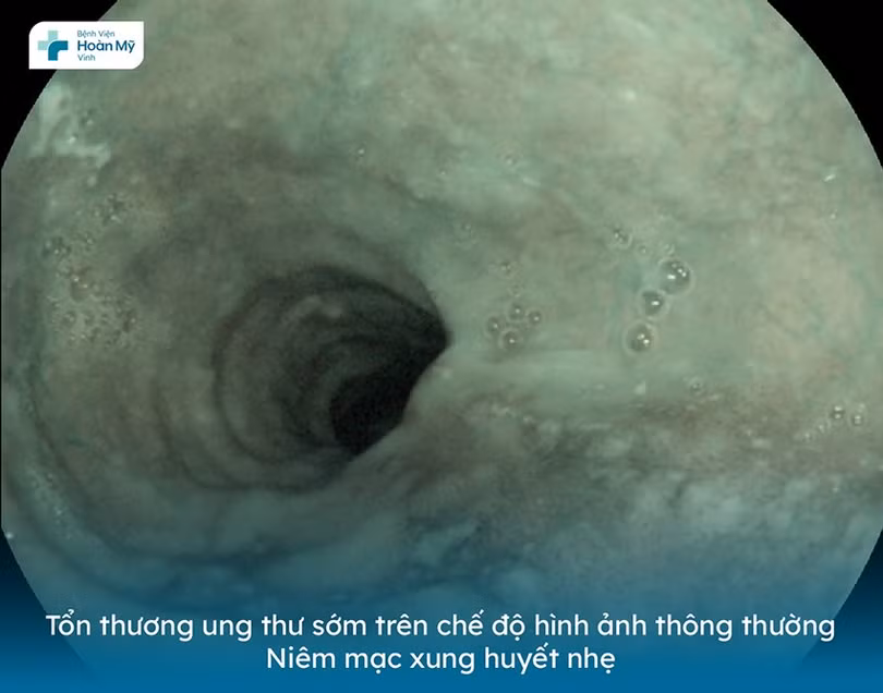 noi-soi-tieu-hoa-benhvienhoanmyvinh-8561.jpg