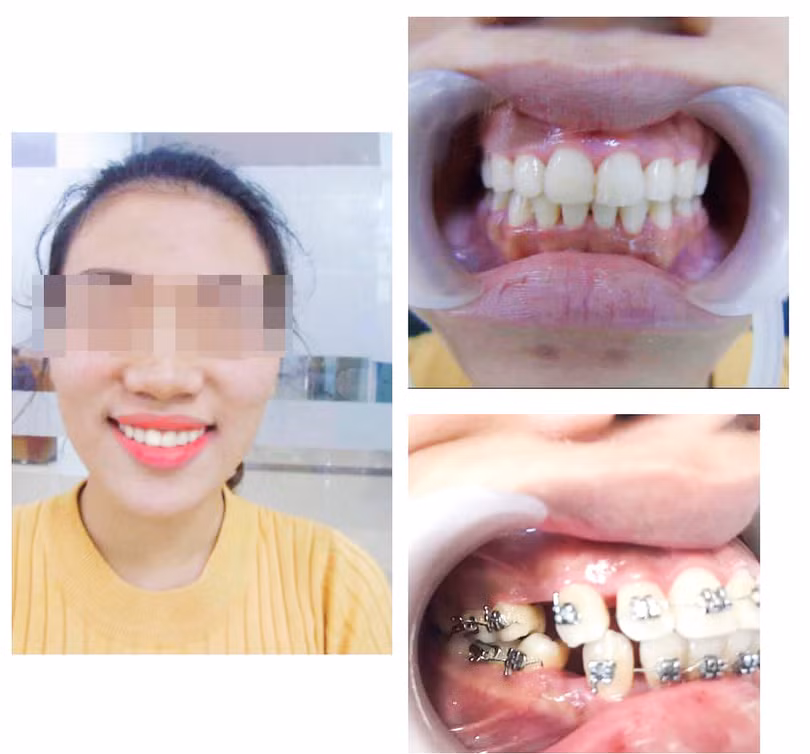 Nhiều bố mẹ “hối tiếc” vì để lỡ giai đoạn vàng niềng răng cho con