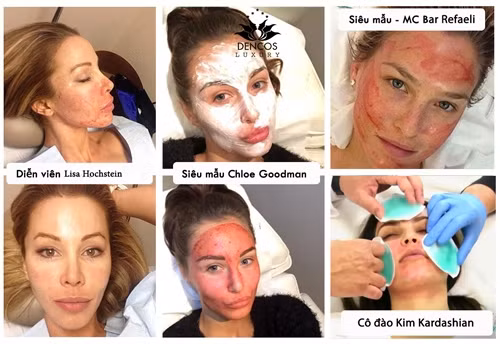 Các ngôi sao nổi tiếng trên thế giới chia sẻ hình ảnh thực hiện Vampire Facelift (Vampire Facial) như một bí quyết trẻ hóa đáng giá.