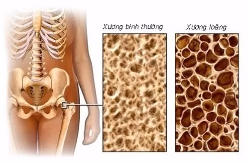 Khi bị loãng xương, mật độ xương giảm dễ dẫn dến gãy tự nhiên.Ảnh:EXSON.