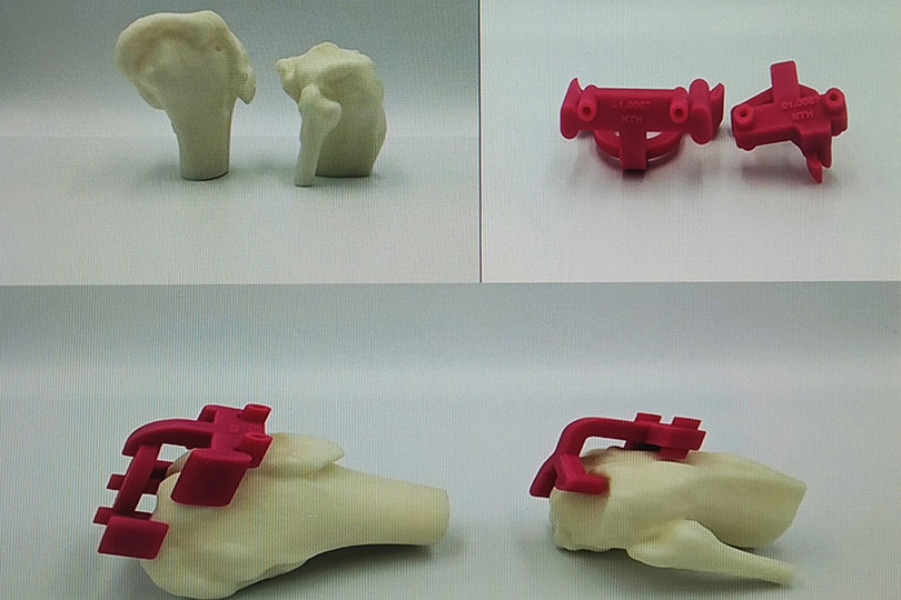 BVĐK Hà Tĩnh ứng dụng công nghệ in 3D vào phẫu thuật thay khớp gối