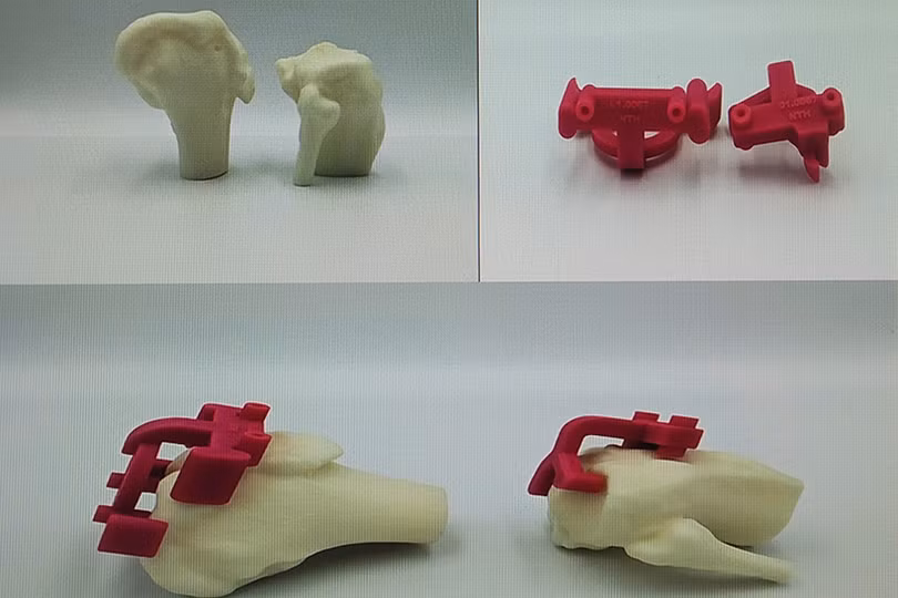 BVĐK Hà Tĩnh ứng dụng công nghệ in 3D vào phẫu thuật thay khớp gối