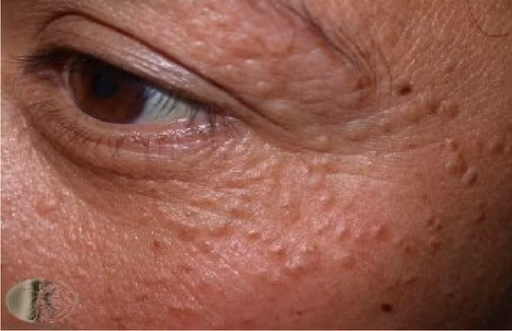 Mụn thịt mọc càng nhiều là do biết “nhảy”?