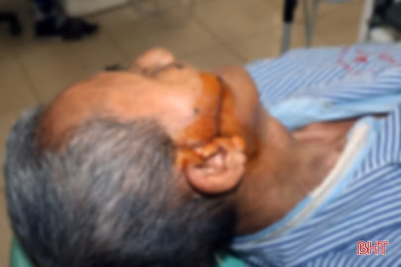 Hà Tĩnh: Phẫu thuật cắt bỏ khối u nang vùng mặt có kích thước lớn