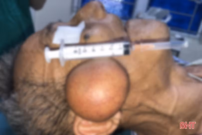 Hà Tĩnh: Phẫu thuật cắt bỏ khối u nang vùng mặt có kích thước lớn