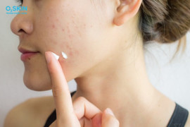 Sống khỏe cùng BHT: Mụn trứng cá ở tuổi dậy thì - Cách phòng ngừa và điều trị hiệu quả