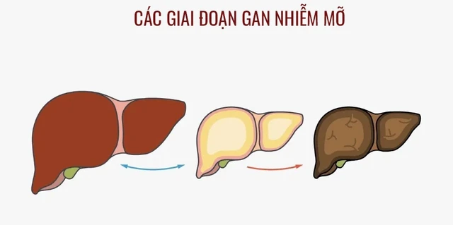 Gan nhiễm mỡ có chữa được không?