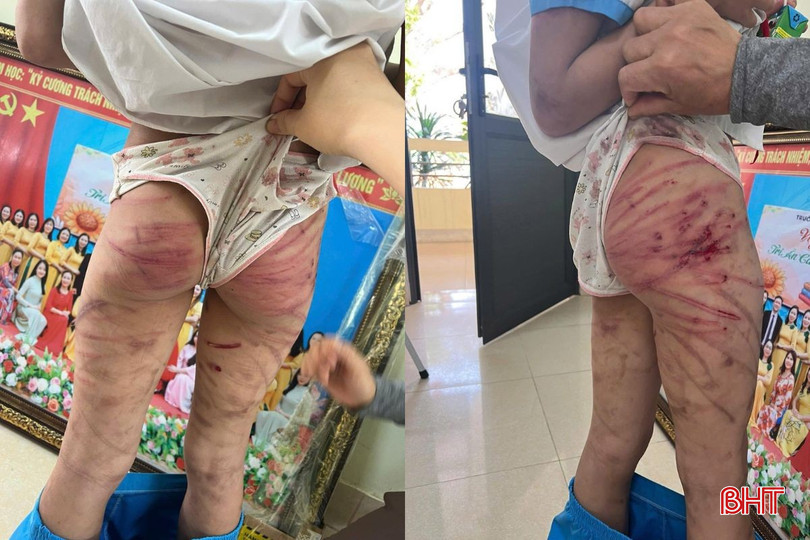Nhà trường đã phối hợp cùng phụ huynh nhanh chóng đưa em đến Bệnh viện Đa khoa thành phố Vinh cấp cứu ngay sau khi thấy vết thương quá nặng. Ảnh: TD. bqbht_br_thiet-ke-chua-co-ten.jpg