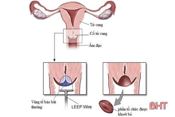 BVĐK Hà Tĩnh triển khai khoét chóp cổ tử cung bằng kỹ thuật mới nhất
