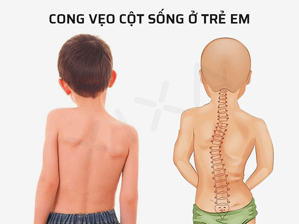 Ngồi đúng tư thế với bàn học chống gù BSUC giảm đến nửa giá