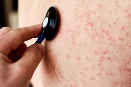 Nhiều trường hợp mắc rubella, dấu hiệu nào nhận biết bệnh sớm?