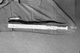 Con lươn dài 30 cm trong bụng người đàn ông