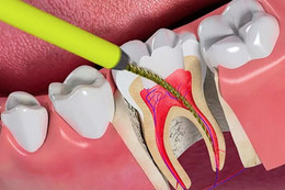 Vì sao cần điều trị tủy răng?