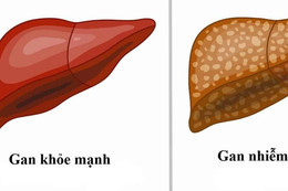 Gan nhiễm mỡ: Nguyên nhân, biểu hiện, điều trị và phòng bệnh