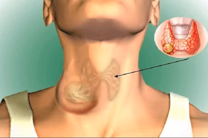 Khi có triệu chứng nghi ngờ ung thư tuyến giáp cần khám sớm để được chẩn đoán chính xác, điều trị đúng cách và kịp thời.