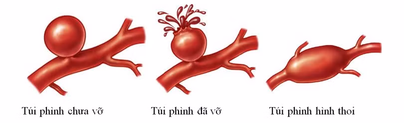 Hình ảnh phình mạch não