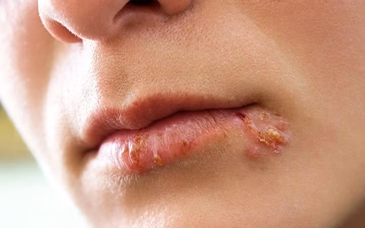 10 căn bệnh của mùa Đông mà ai cũng có thể mắc phải