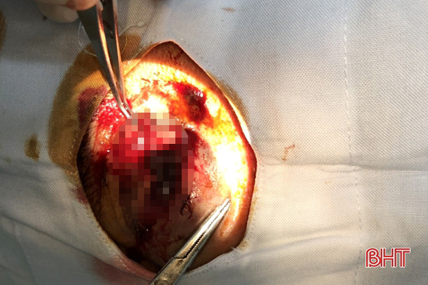 Xẻ gạch, mảnh lưỡi cưa văng làm vỡ nhãn cầu