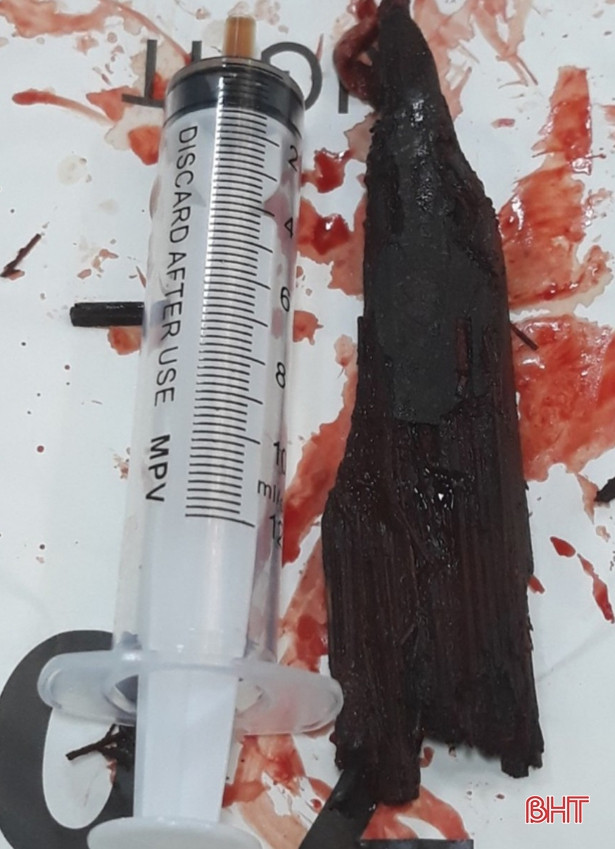 BVĐK Đức Thọ phẫu thuật lấy dị vật 12cm xuyên thủng tay bệnh nhân