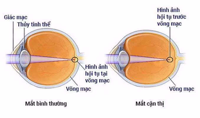 Kiểm soát tiến triển cận thị ở trẻ em