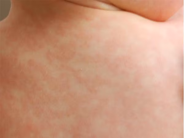 7 vấn đề sức khỏe mùa nắng nóng và cách phòng chống