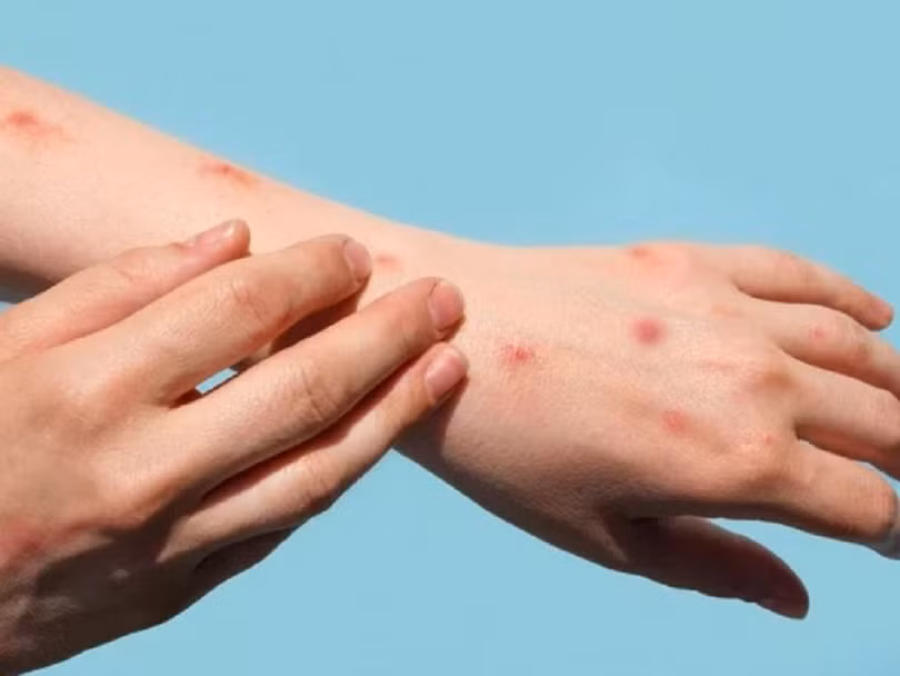 Việt Nam đã ghi nhận 56 ca đậu mùa khỉ, Bộ Y tế “nhắc” giám sát, phát hiện sớm người mắc