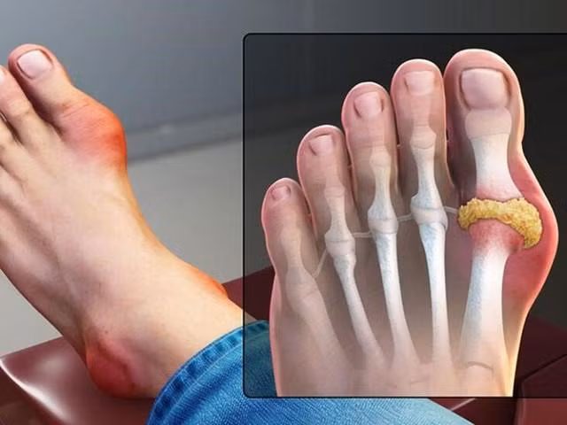 Uống nước chanh giúp người bệnh giảm bớt các triệu chứng của bệnh gout.