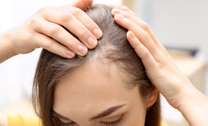 Nhiều người trẻ đang phải đối mặt với tình trạng tóc mỏng, thưa và rụng sớm.