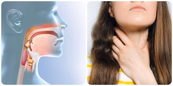Nếu khối u phát triển xung quanh các dây thanh, sẽ dẫn đến việc thay đổi giọng nói.
