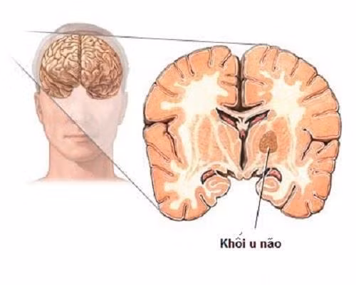 U não gồm u não lành tính và u não ác tính
