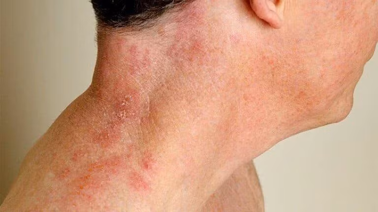 Ở người lớn tuổi do virus Varicella – Zoster tái hoạt động và tấn công vào các dây thần kinh gây ra tình trạng đau rát, nổi mụn nước.