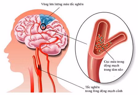 Chất chuyển hóa có liên quan đến nguy cơ đột quỵ