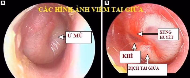 Trẻ bị viêm tai giữa - chăm sóc như thế nào?