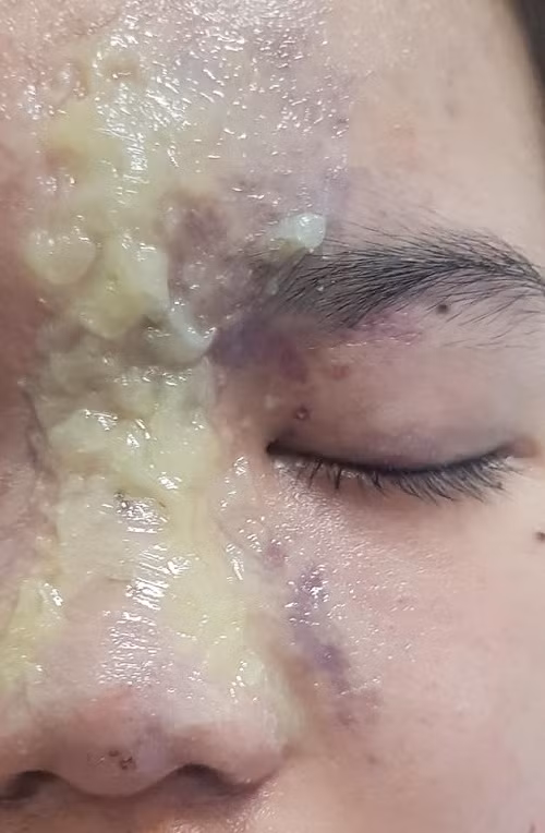 Nữ sinh 15 tuổi mù mắt sau khi tiêm filler nâng mũi