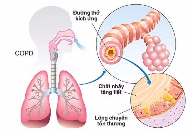 Hoa đu đủ chữa bệnh phổi tắc nghẽn mạn tính